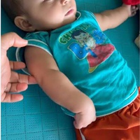 Erb's palsy